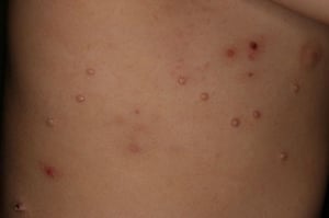 Molluscum Contagiosum