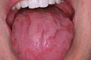 Geographic Tongue