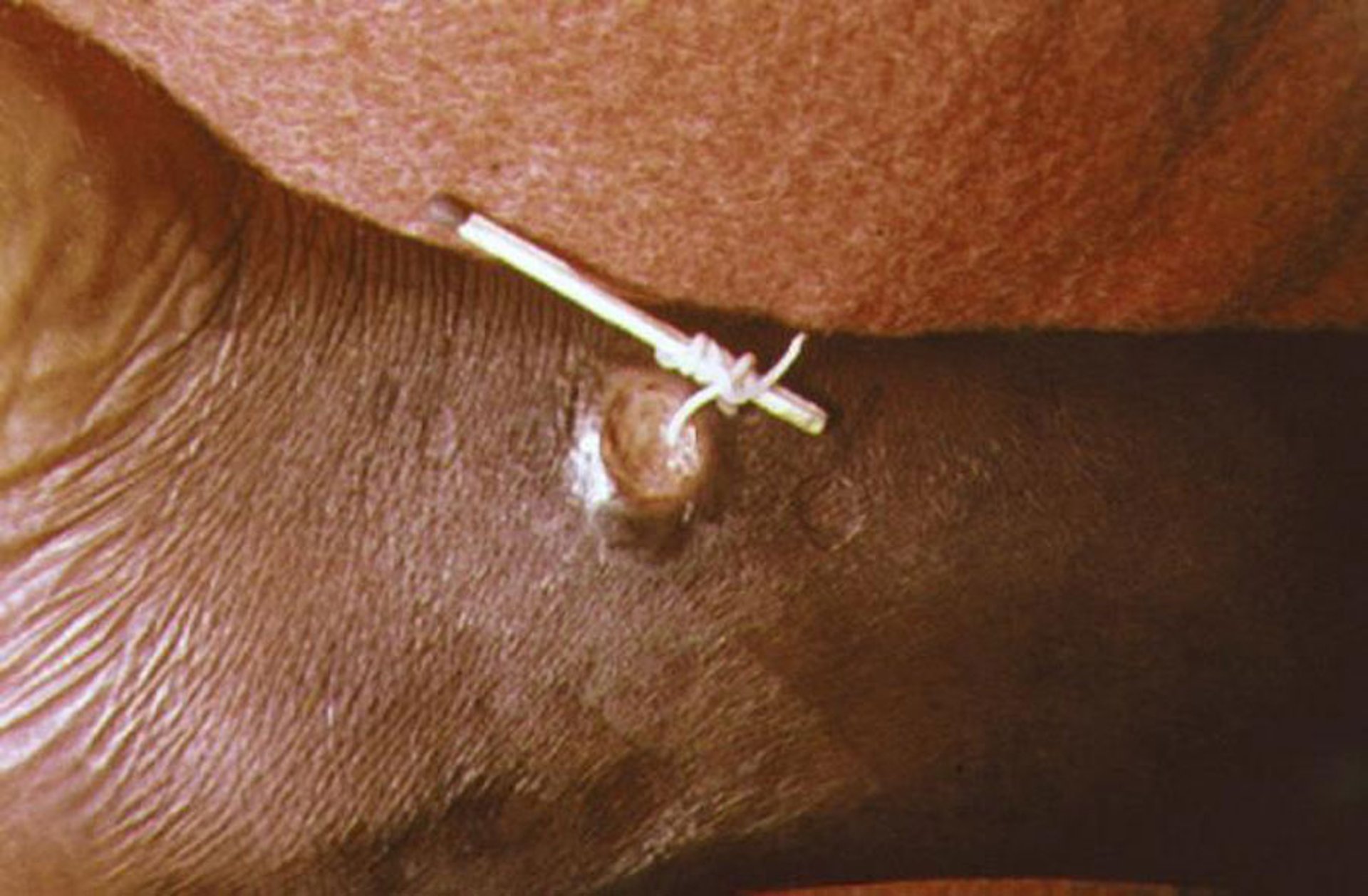 Guinea Worm Extraction