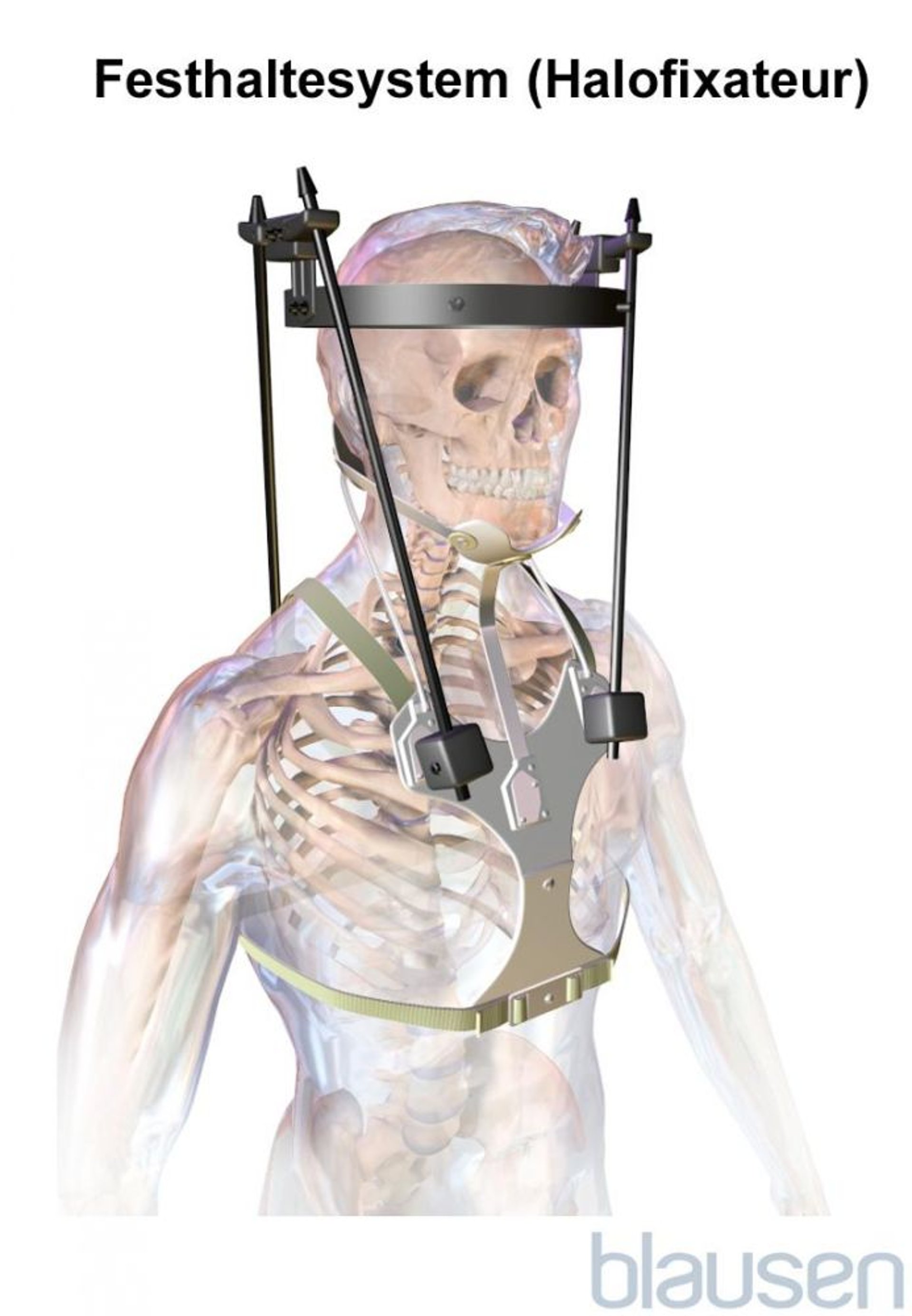 Festhaltesystem (Halofixateur)