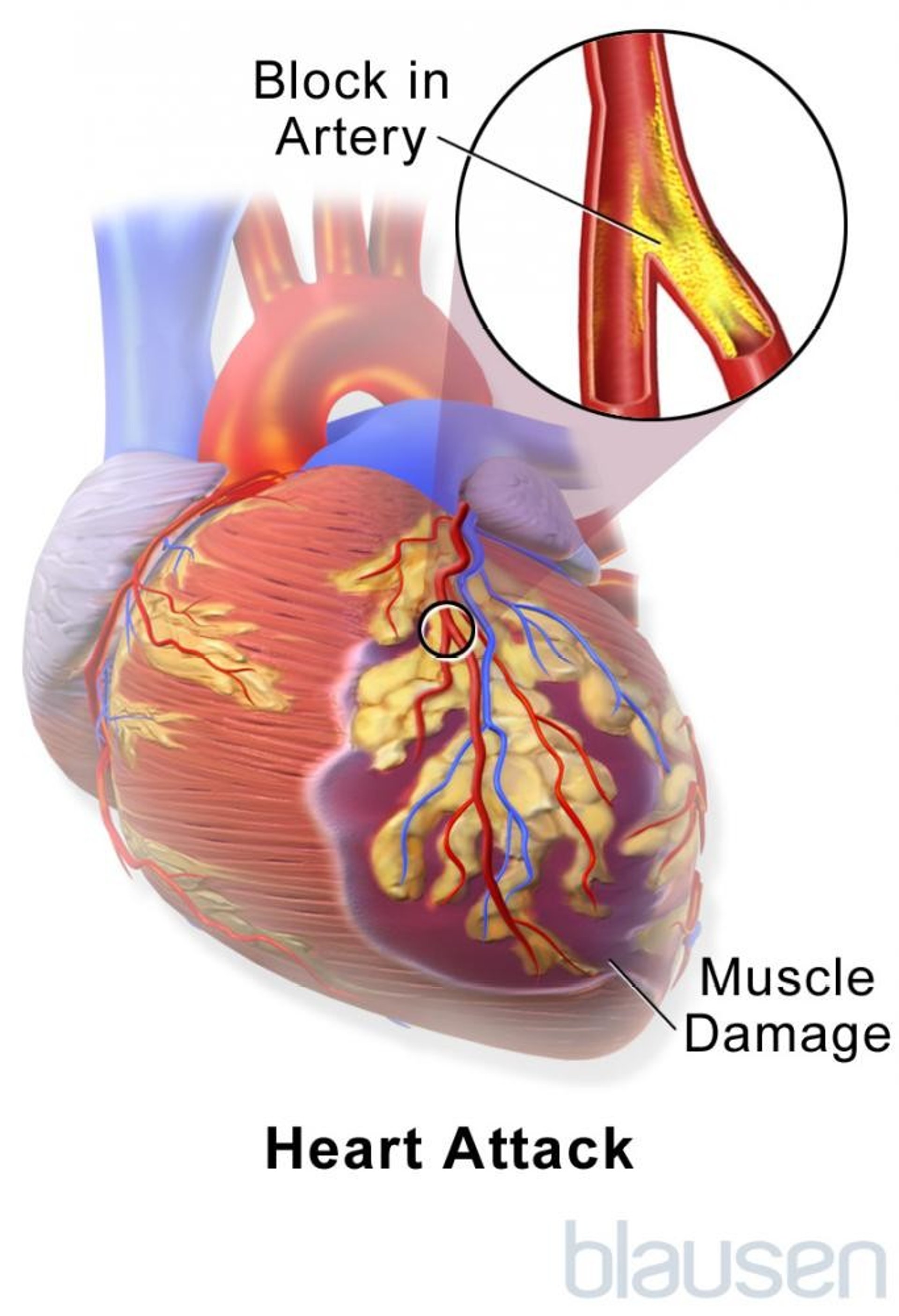 Heart Attack