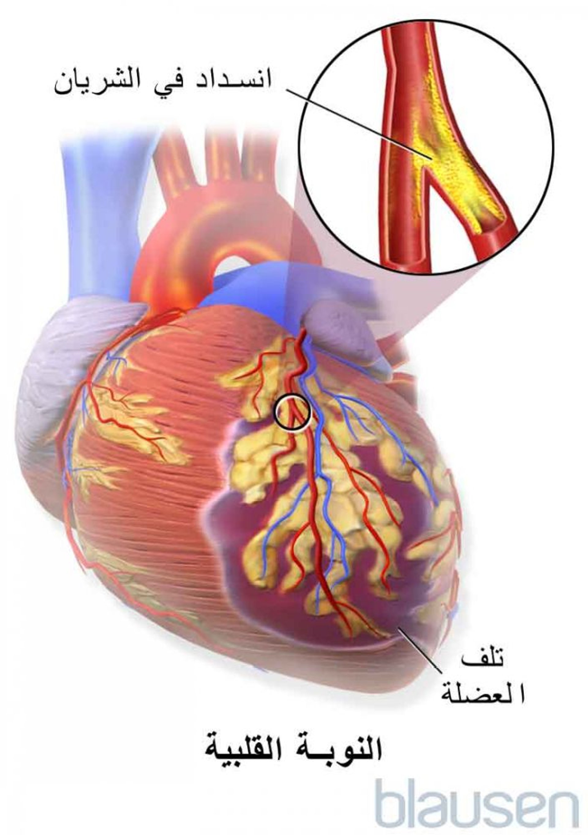 النوبة القلبية