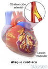 Infarto de miocardio
