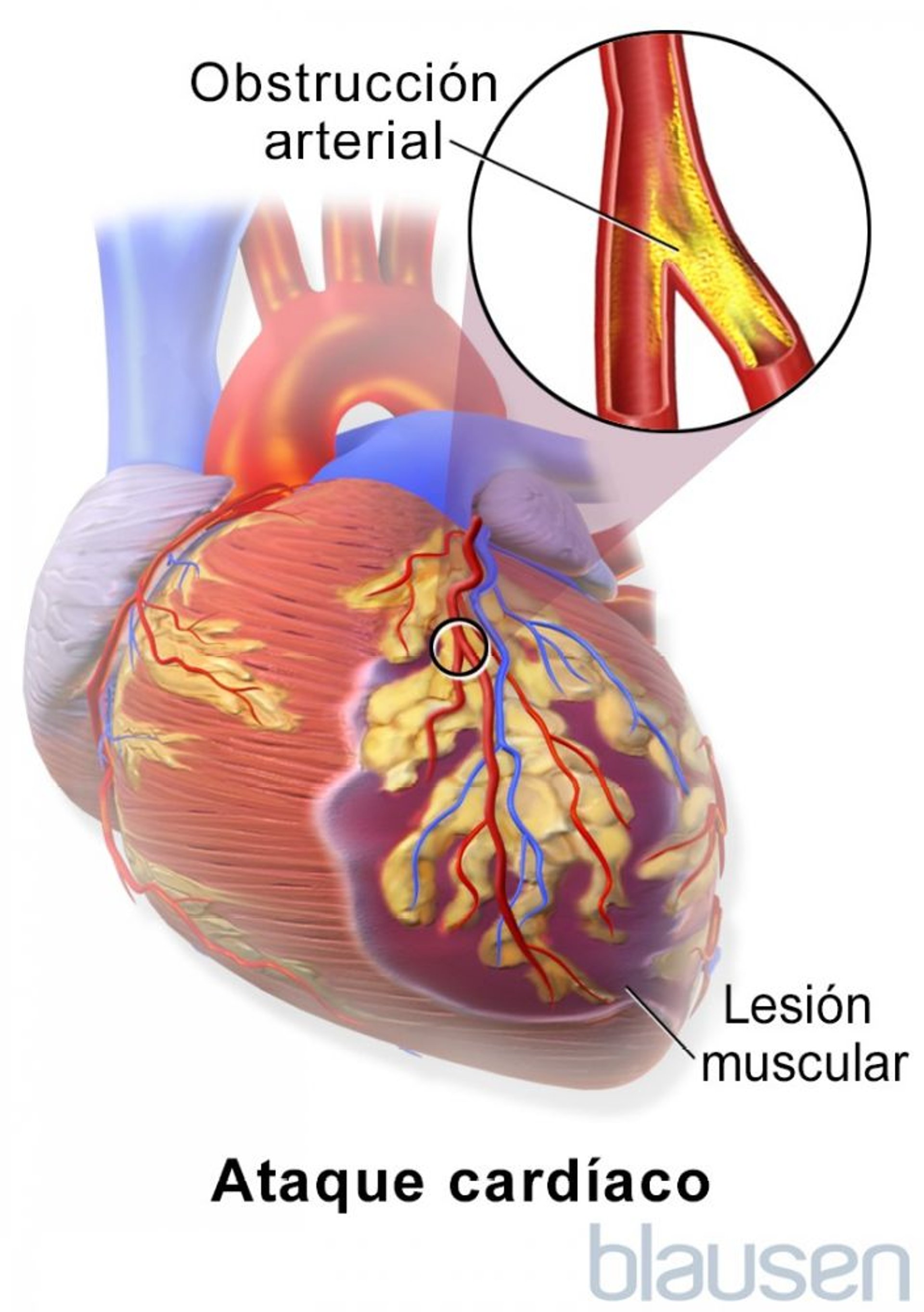 Infarto de miocardio
