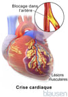 Crise cardiaque