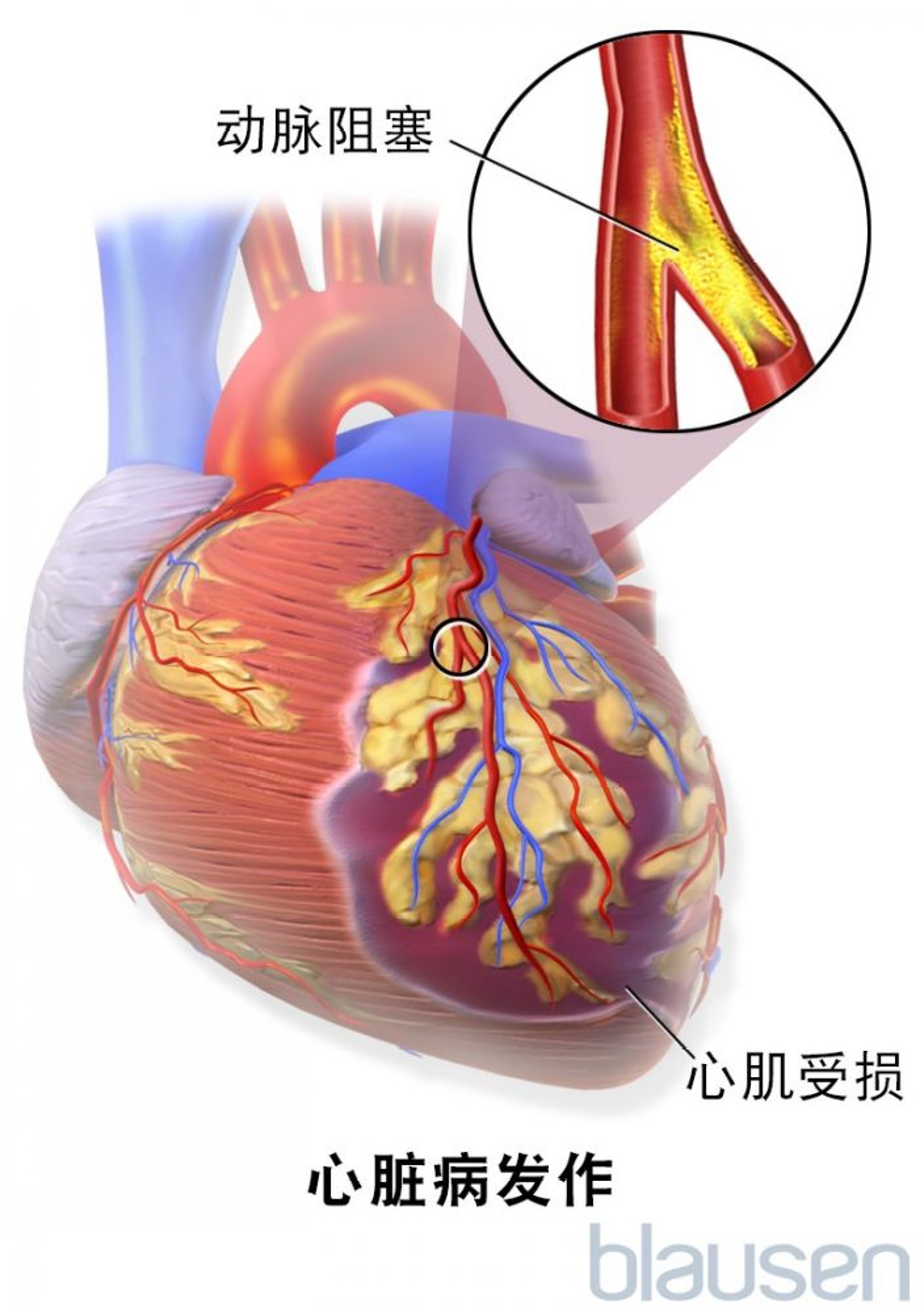 心脏病发作