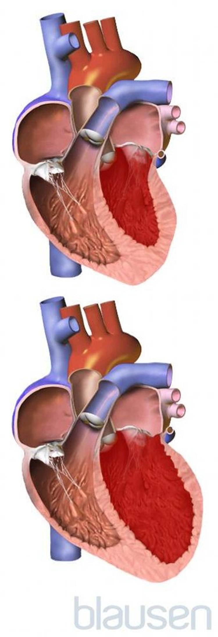 Coração normal versus coração aumentado