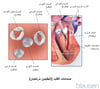 صمامات القلب (البطينان منبسطان)
