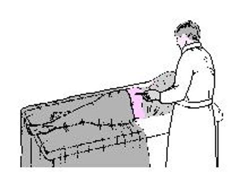 Prélèvement de moelle osseuse