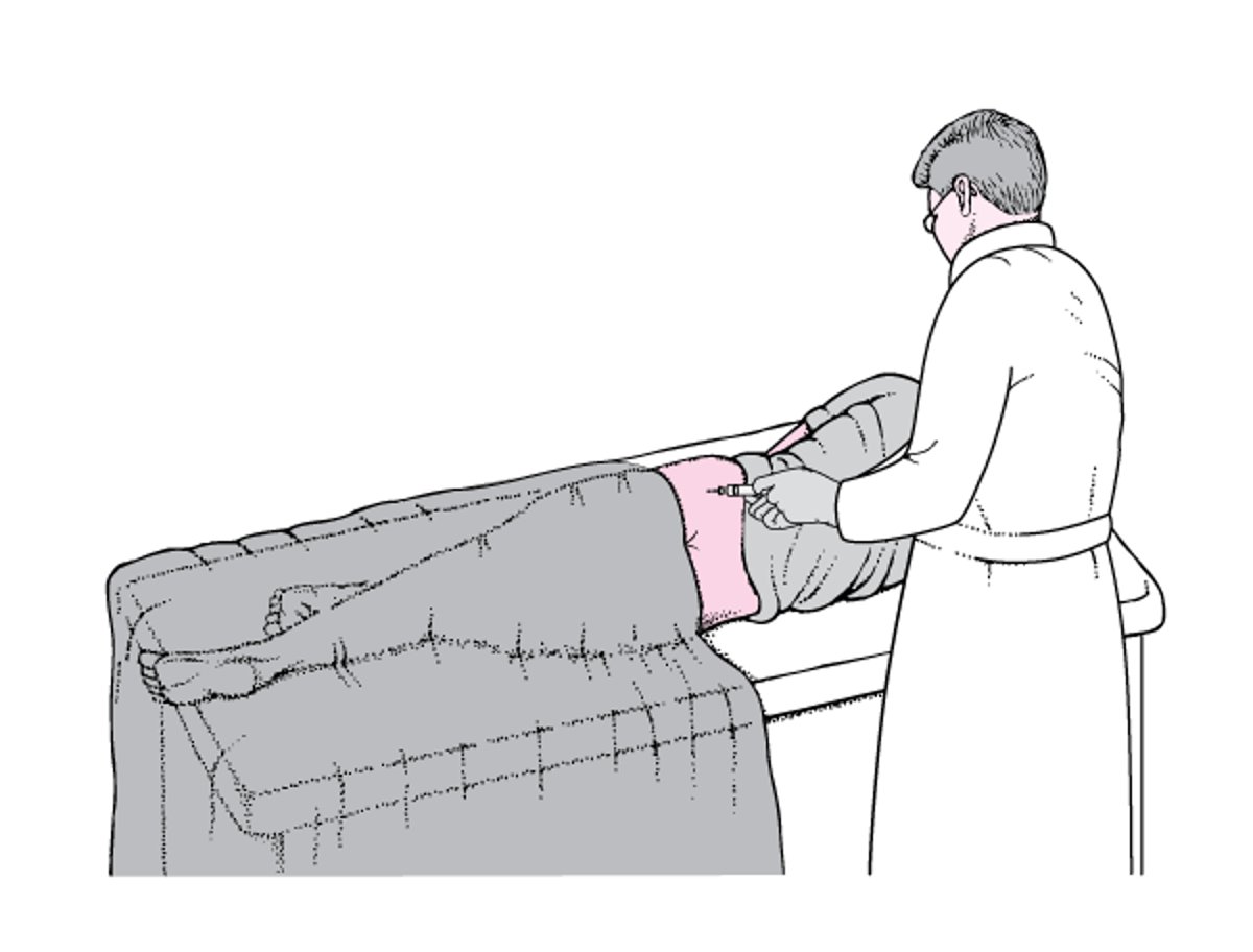 骨髄サンプル採取