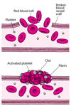 Blood Clots: Plugging the Breaks