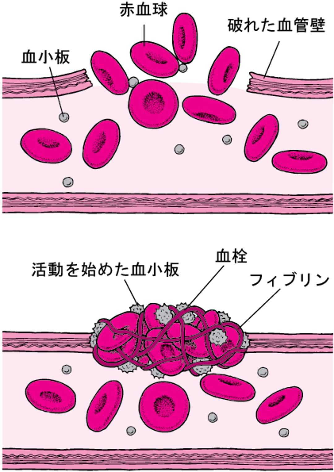 血栓：血管の破れ目をふさぐ