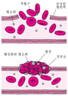 피떡: 파괴 부위 메우기