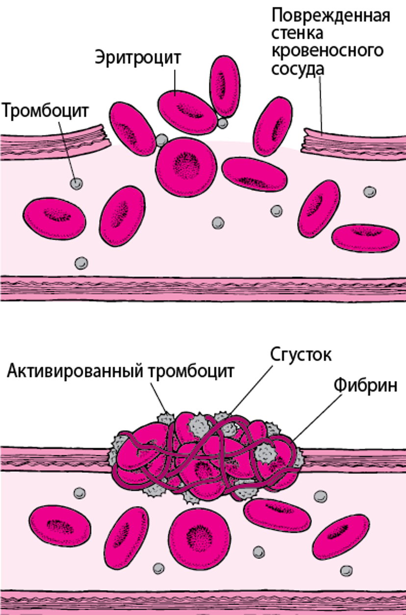 Сгустки крови: закупоривание разрывов