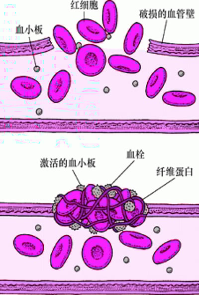 血凝块：堵塞破损部位