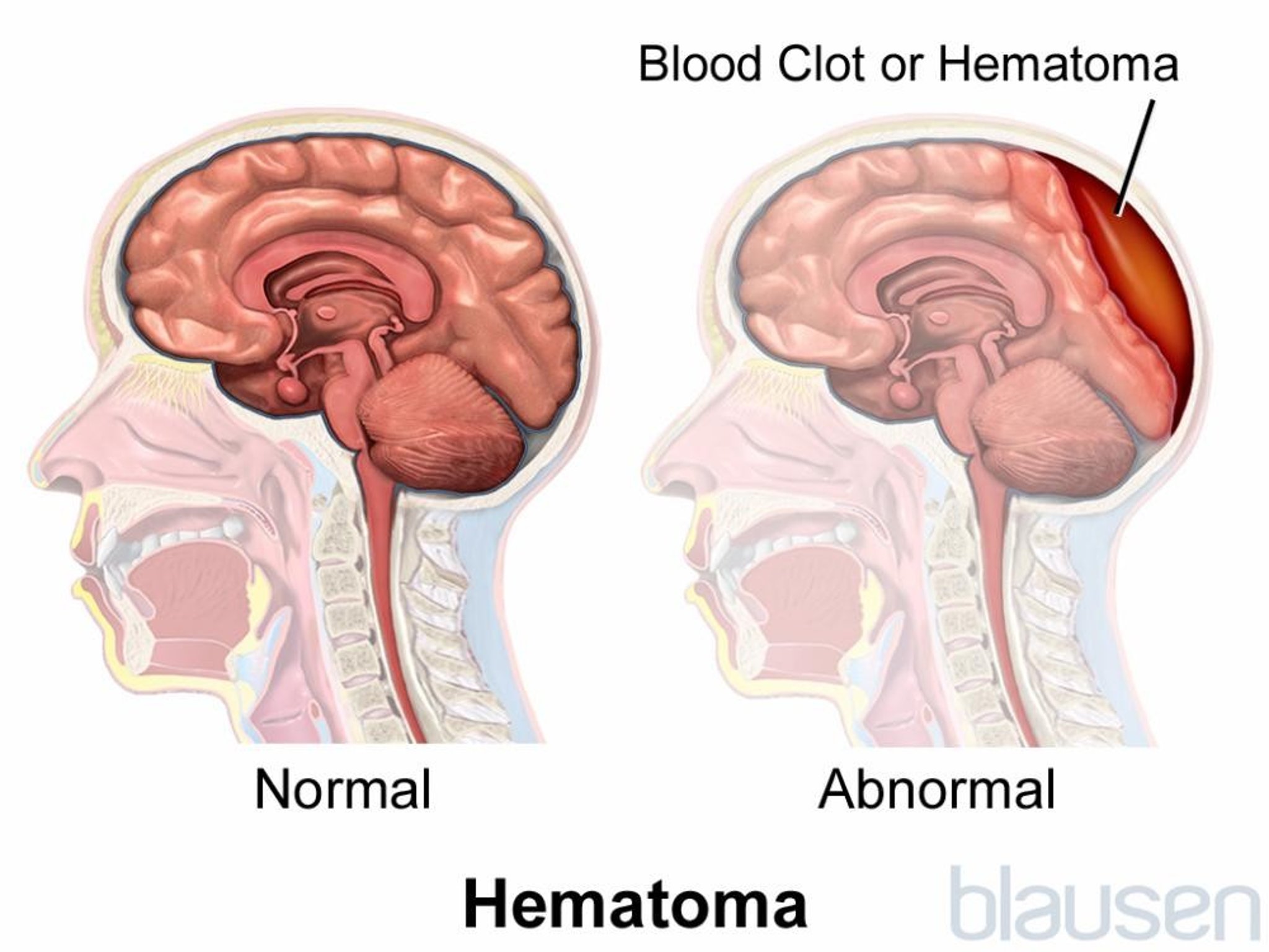 Hematoma