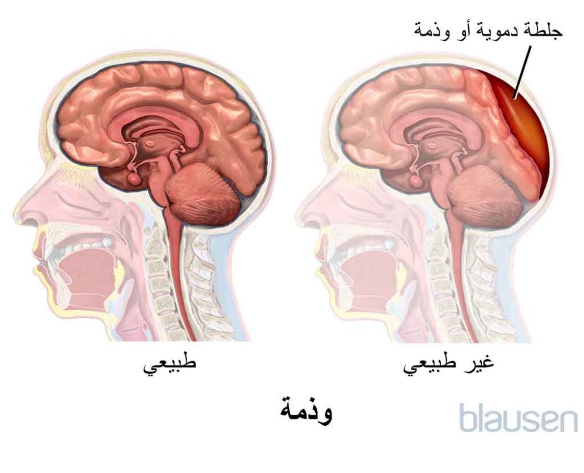 الورم الدموي