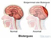 Bluterguss