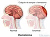 Hematoma