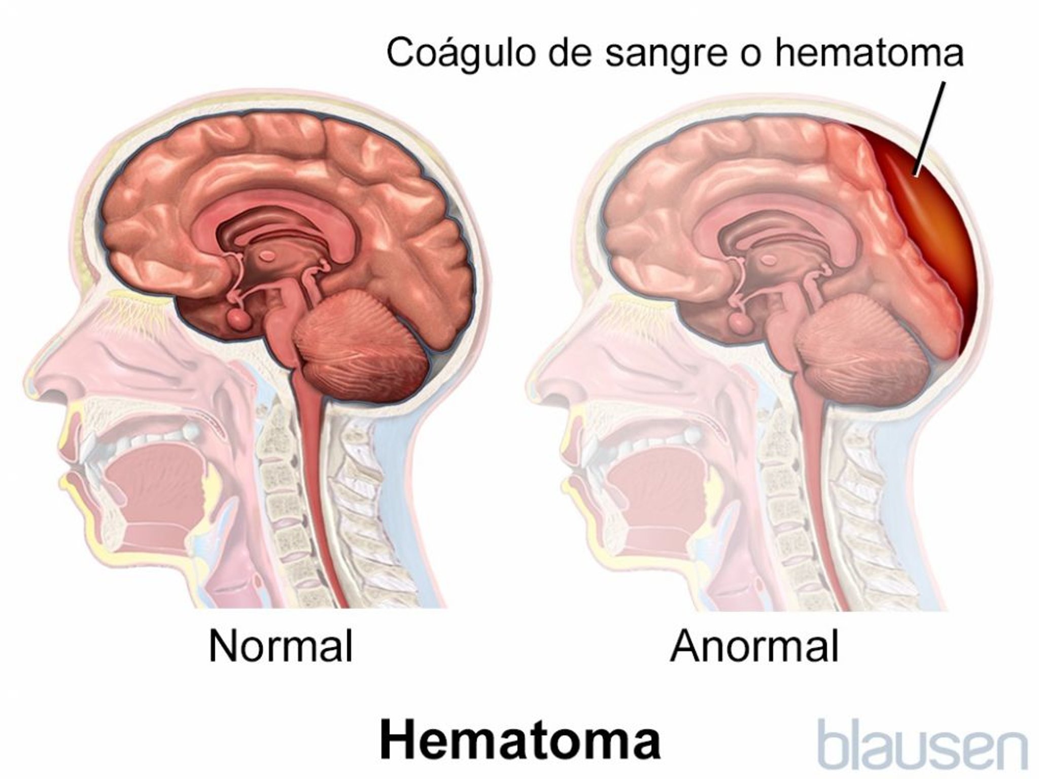 Hematoma