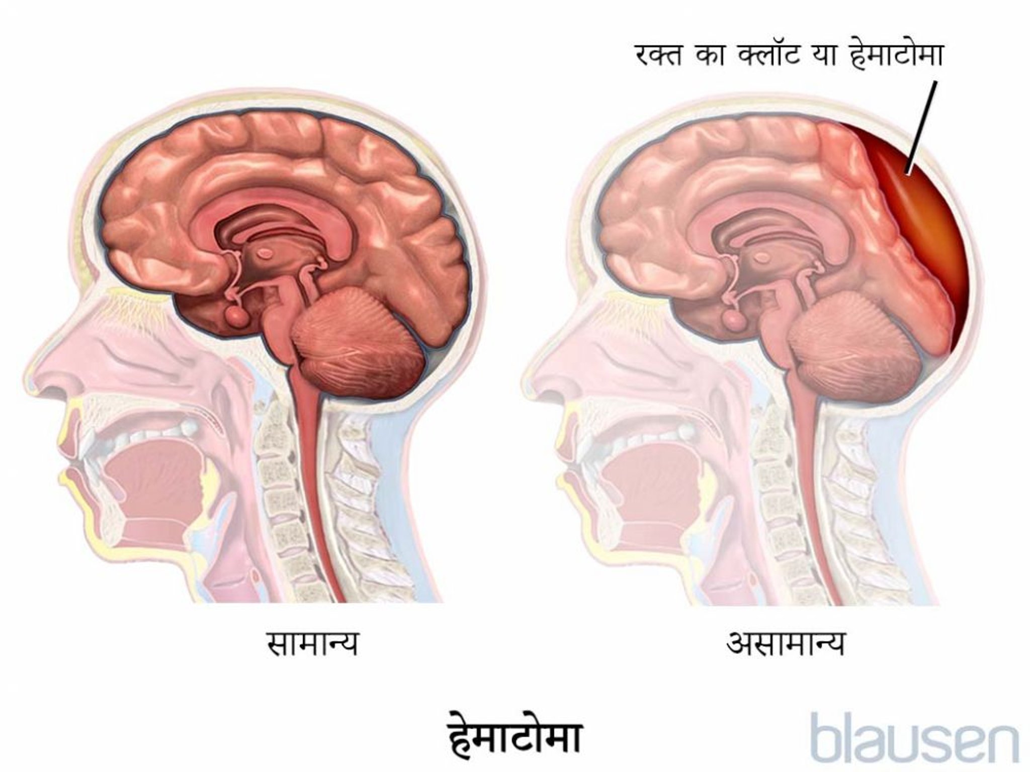 हेमाटोमा