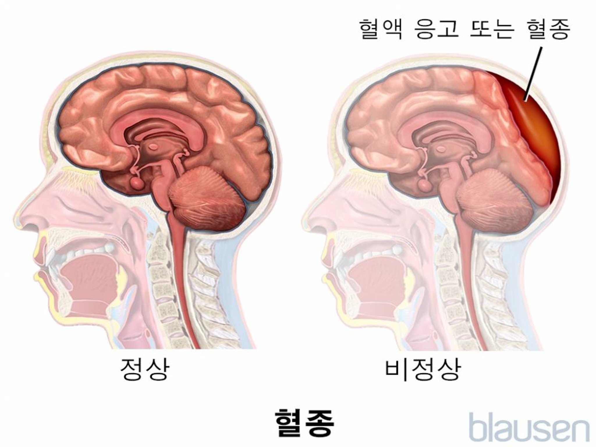 혈종