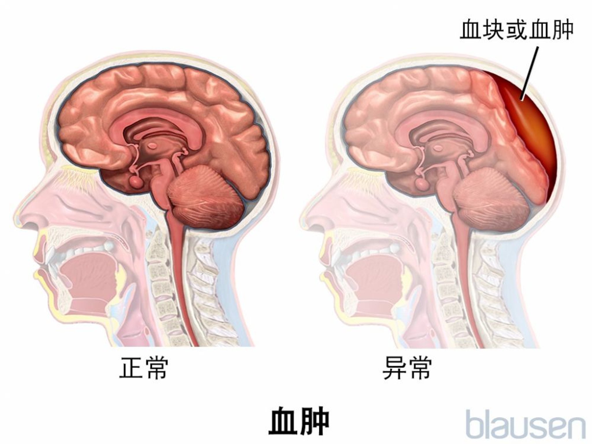 血肿