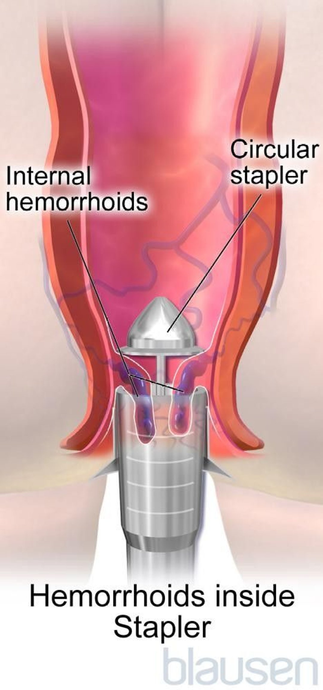 Hemorrhoidopexy