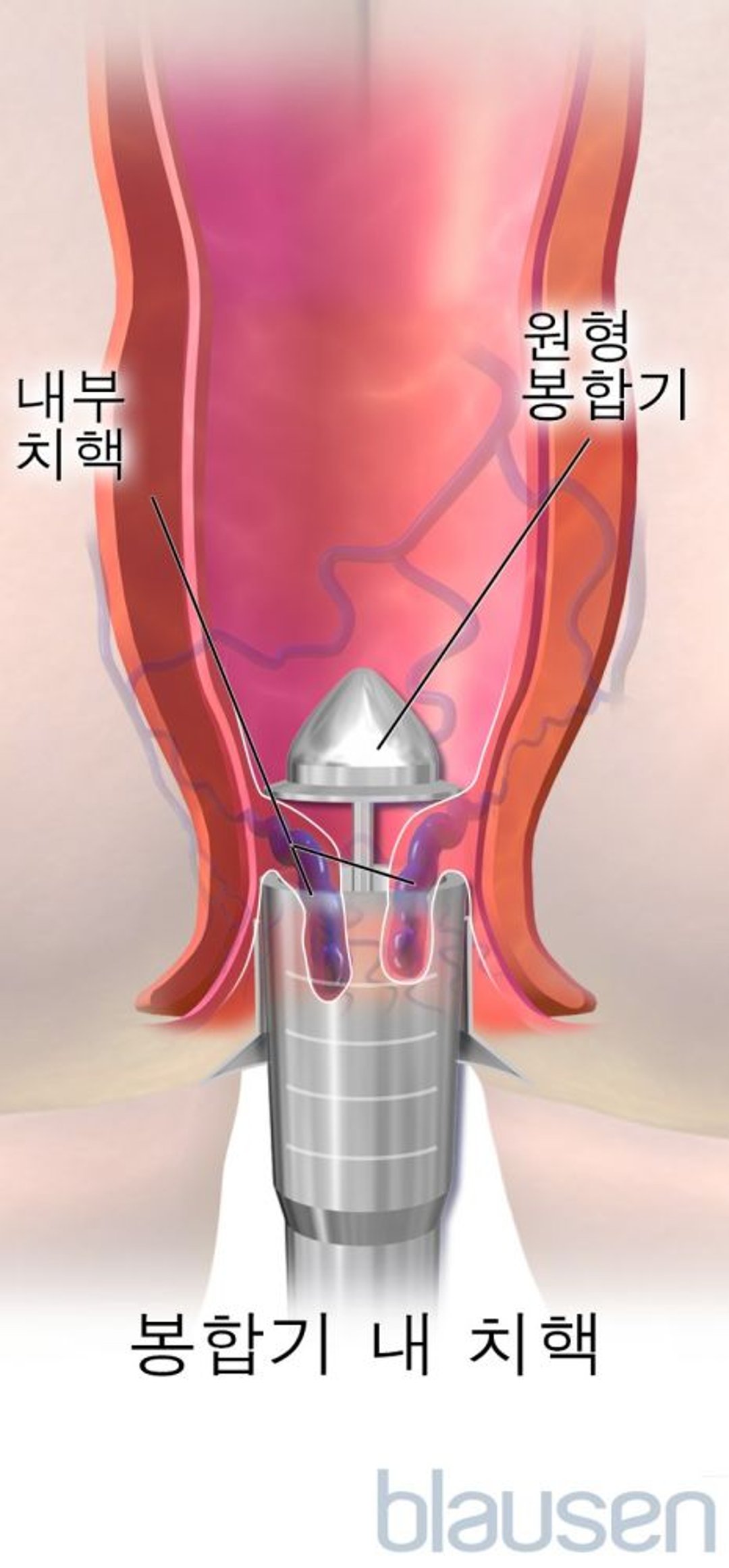 치핵고정술