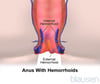 Hemorrhoids