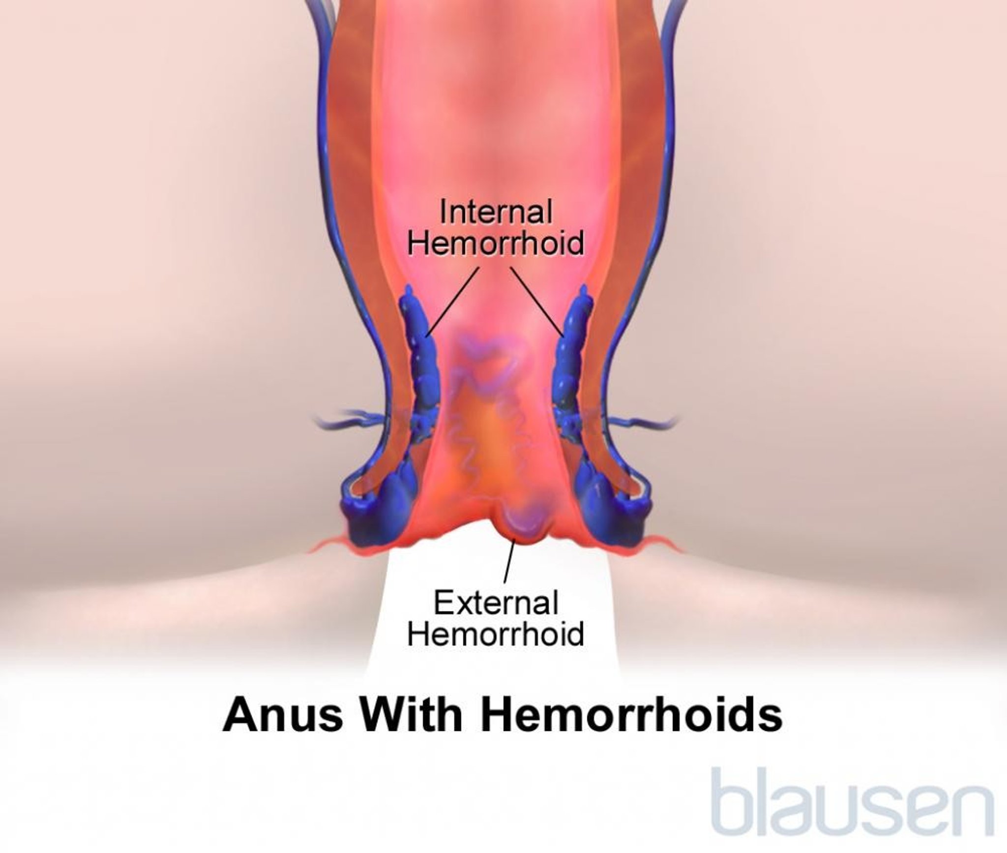 Hemorrhoids