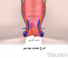 البواسير
