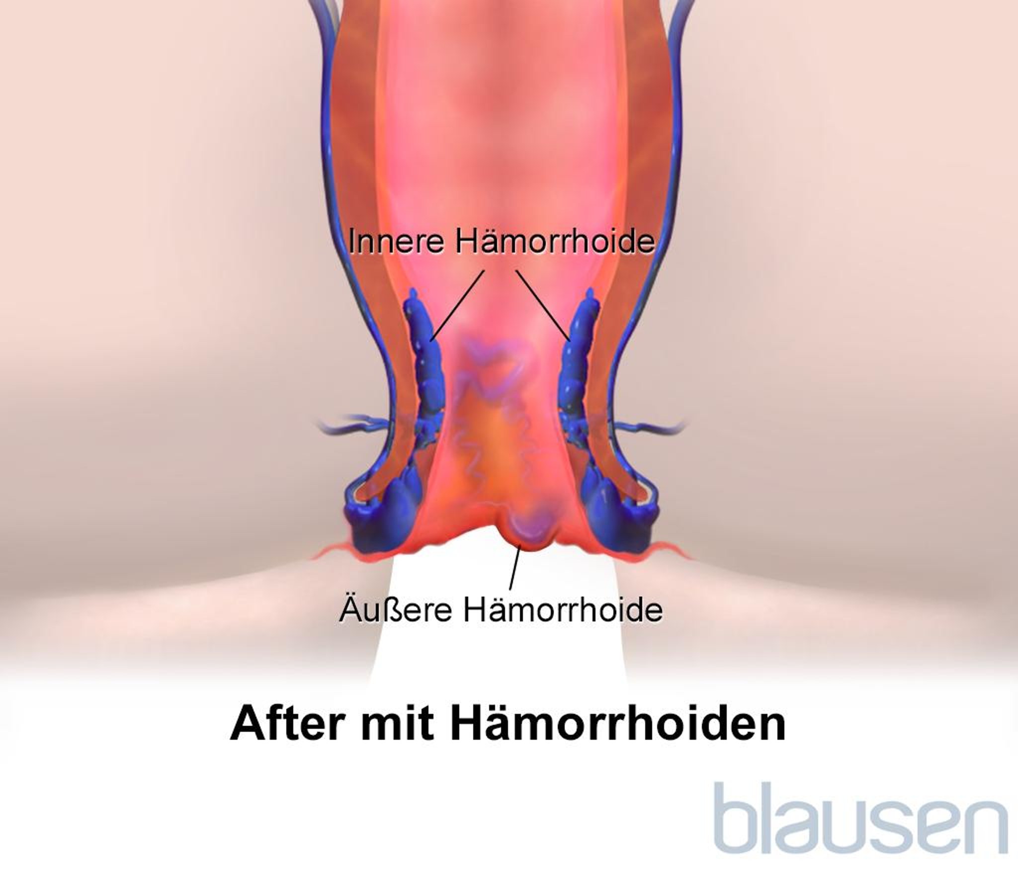 Hämorrhoiden