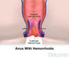 Hemorroides
