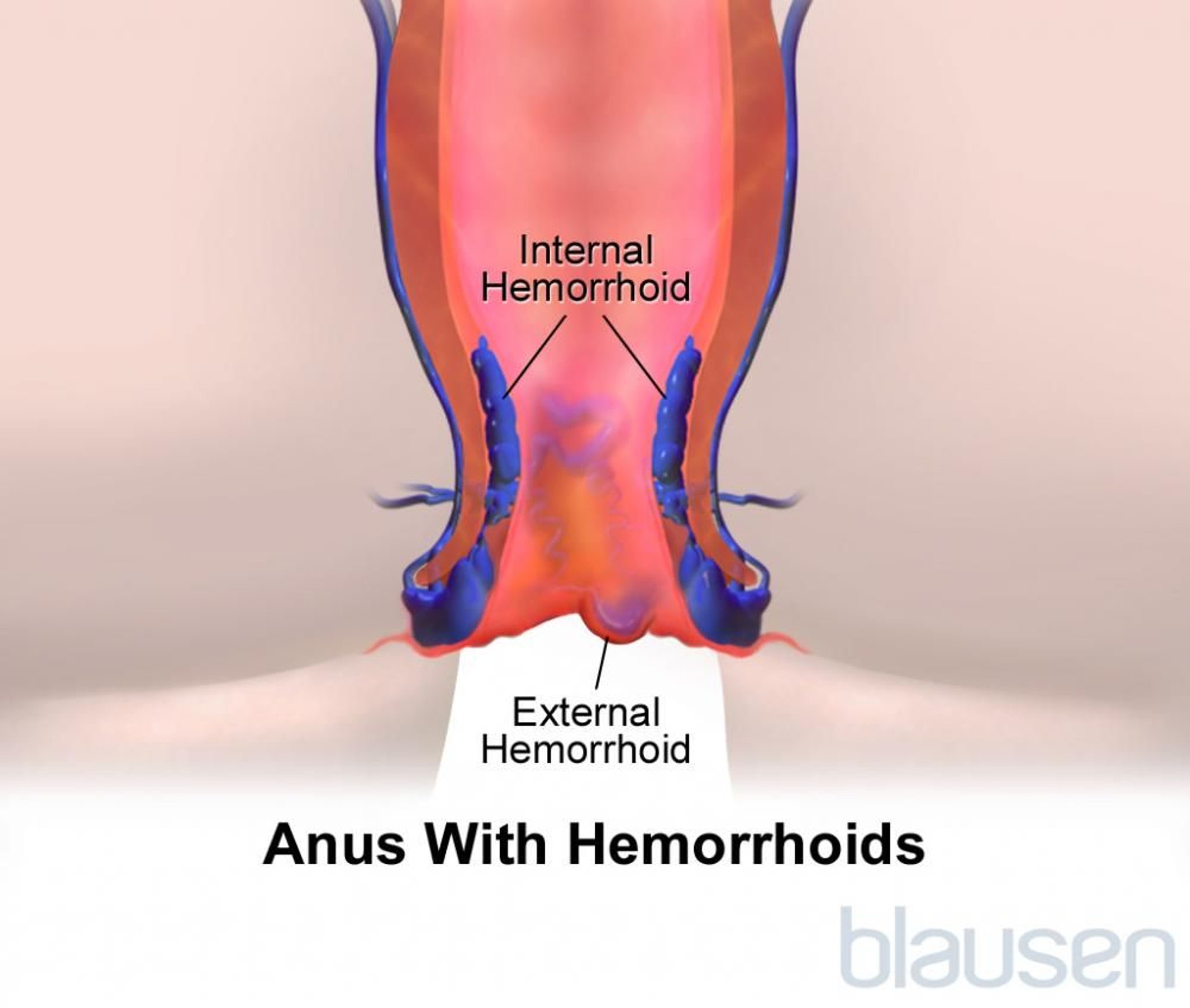 Hemorroides