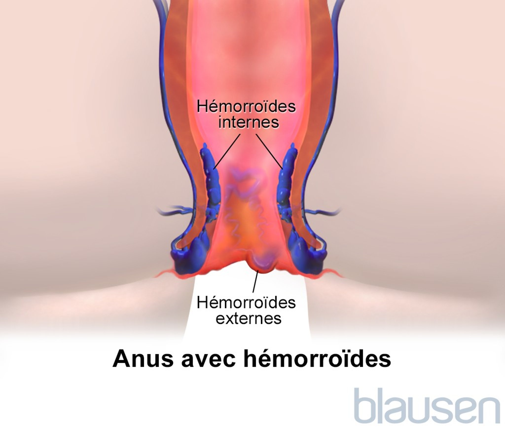 Hémorroïdes