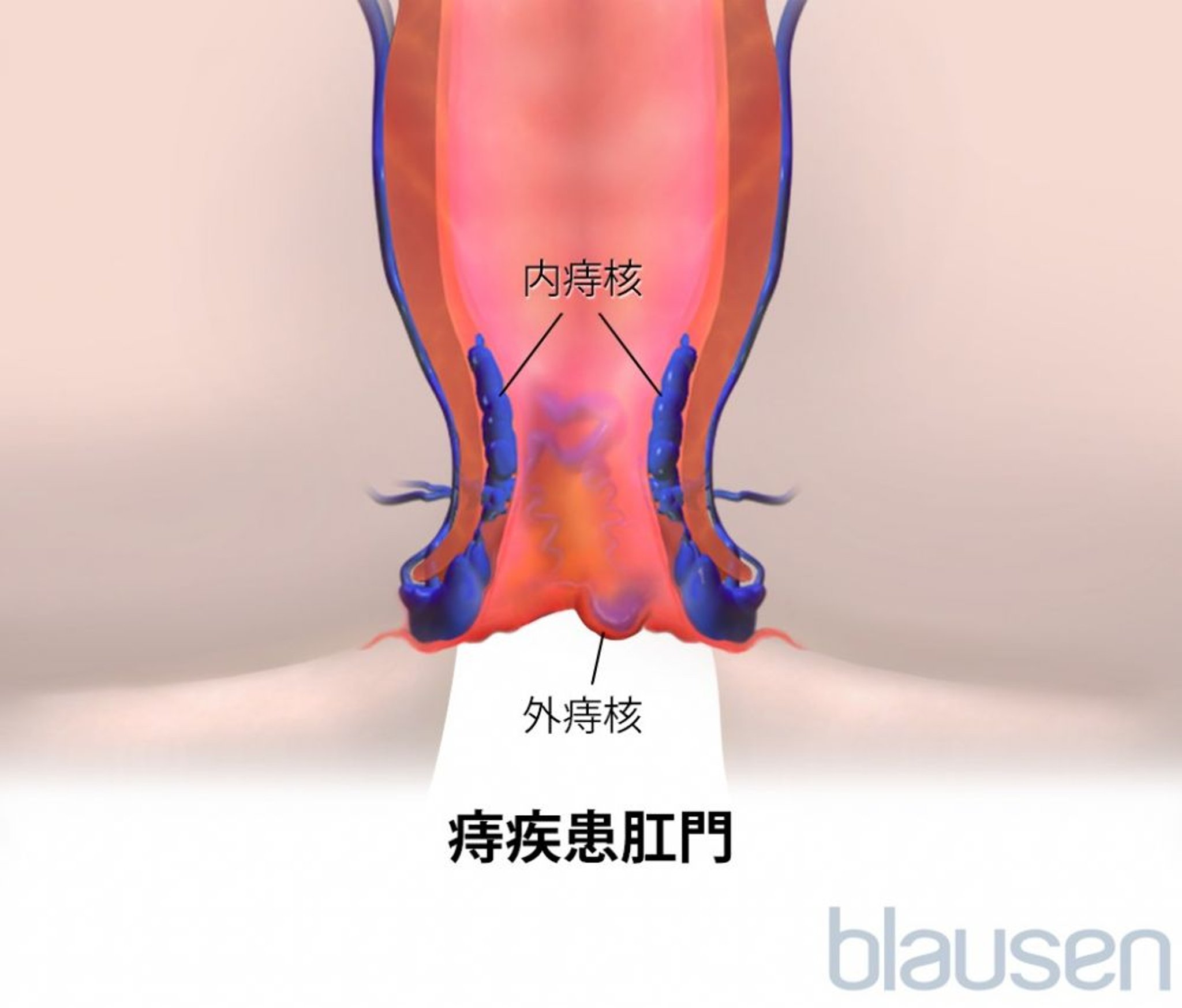 <ruby >痔核<rt >じかく</rt></ruby>