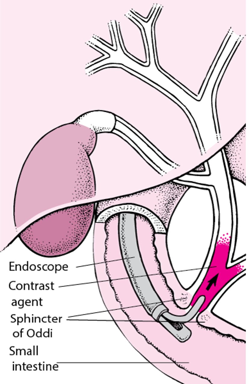 Understanding Endoscopic Retrograde Cholangiopancreatography (ERCP)