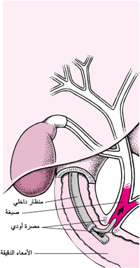 فَهم تصوير البنكرياس والقنوات الصفراويَّة التنظيري بالطريق الرَّاجع (ERCP)