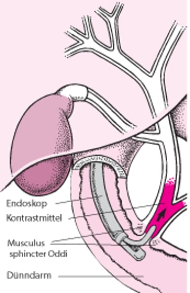 Erläuterung der endoskopisch retrograden Cholangiopankreatikographie (ERCP)