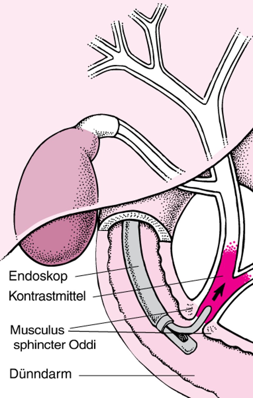 Erläuterung der endoskopisch retrograden Cholangiopankreatikographie (ERCP)