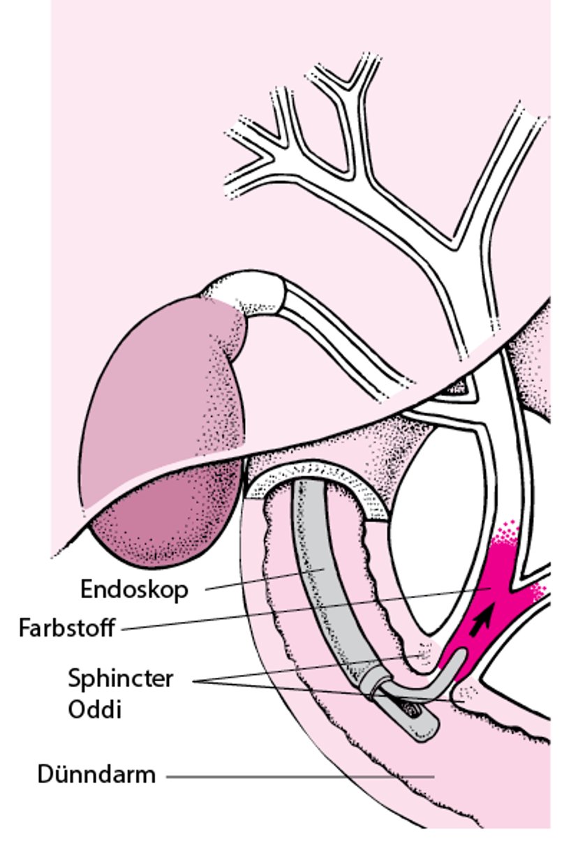 Erläuterung der endoskopisch retrograden Cholangiopankreatikographie (ERCP)
