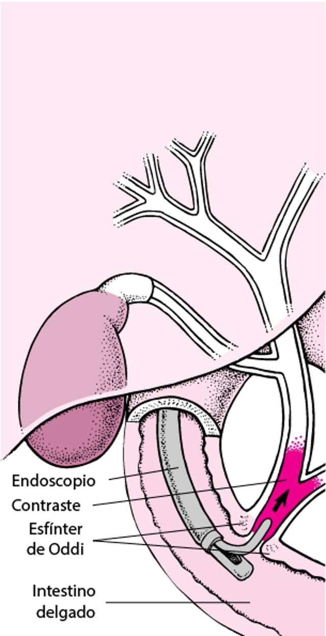 Qué es la colangiopancreatografía retrógrada endoscópica