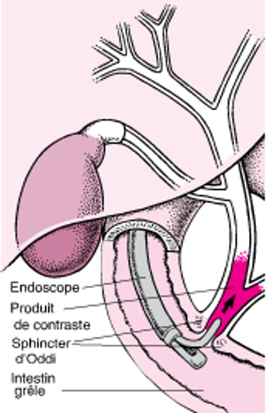 Comprendre la cholangiopancréatographie rétrograde endoscopique (CPRE)