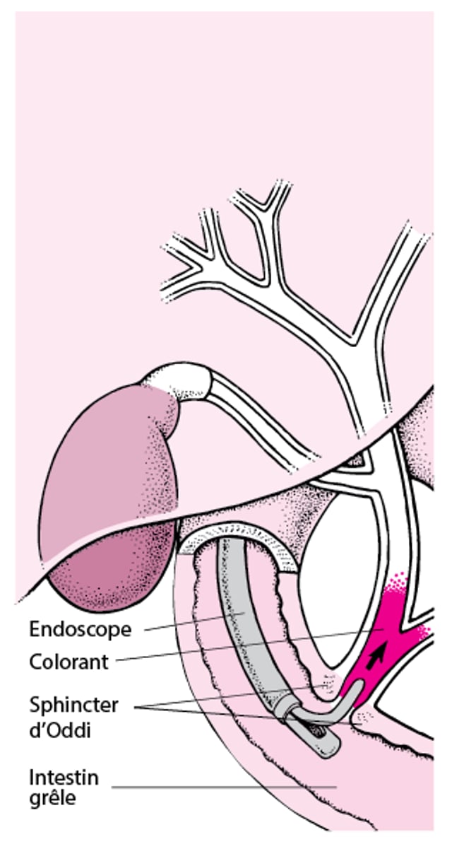 Comprendre la cholangiopancréatographie rétrograde endoscopique (CPRE)