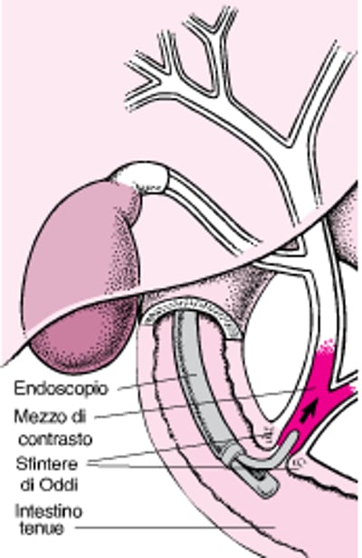 Conoscere la colangiopancreatografia retrograda endoscopica (CPRE)