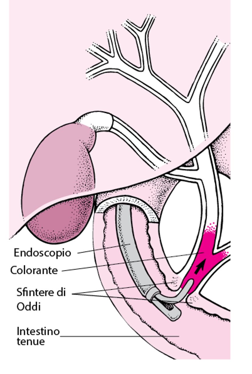 Conoscere la colangiopancreatografia retrograda endoscopica