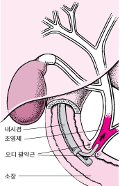 내시경 역행 쓸개이자조영술(ERCP)에 대한 이해