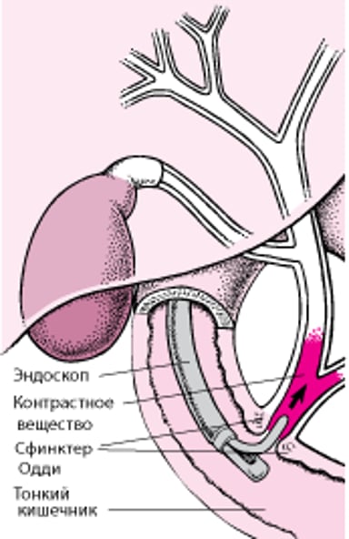 Понимание процедуры эндоскопической ретроградной холангиопанкреатографии (ЭРХПГ)