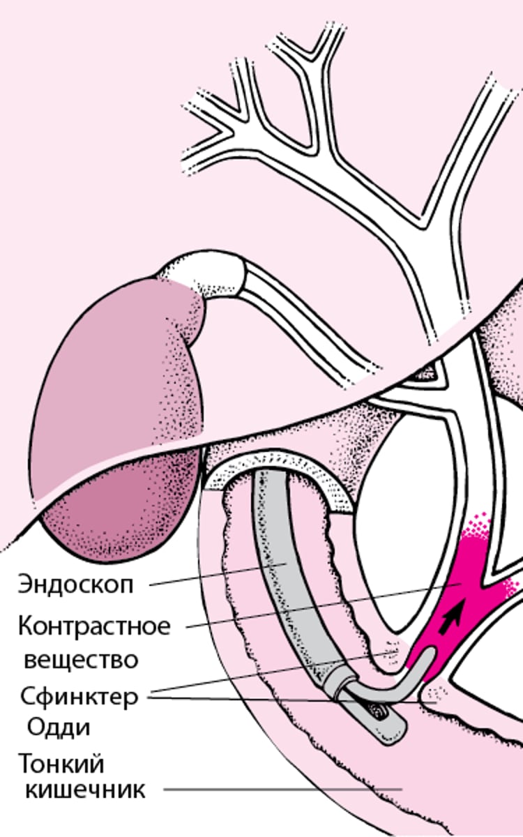 Понимание процедуры эндоскопической ретроградной холангиопанкреатографии (ЭРХПГ)